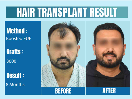 Are You the Right Candidate for a Hair Transplant in Delhi?